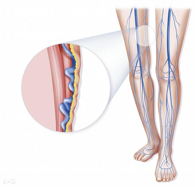 最新下肢静脉曲张诊疗技术与方法研究探讨
