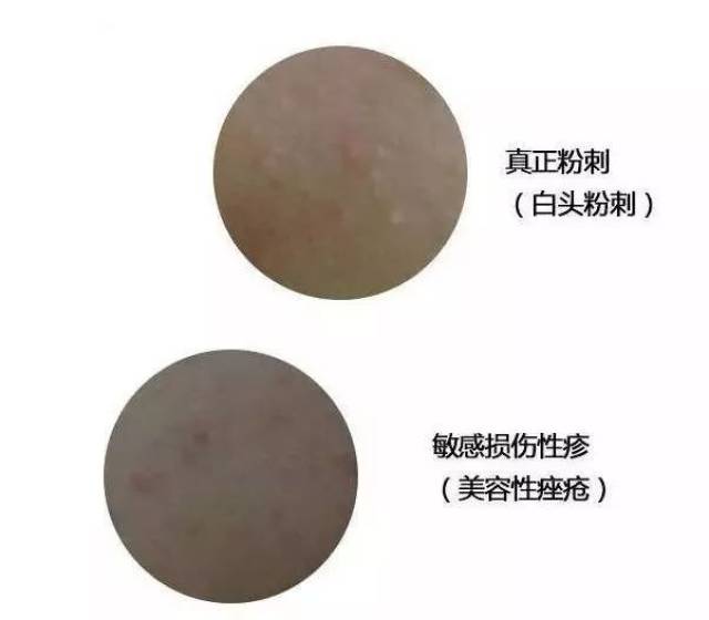 粉刺新态势解析与防治策略研究