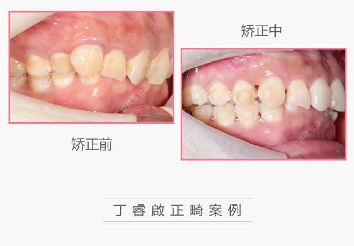 牙齿深覆合最新进展与应对策略介绍