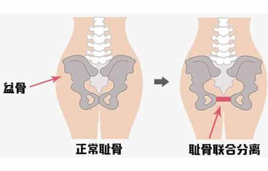 孕期耻骨最新信息解析