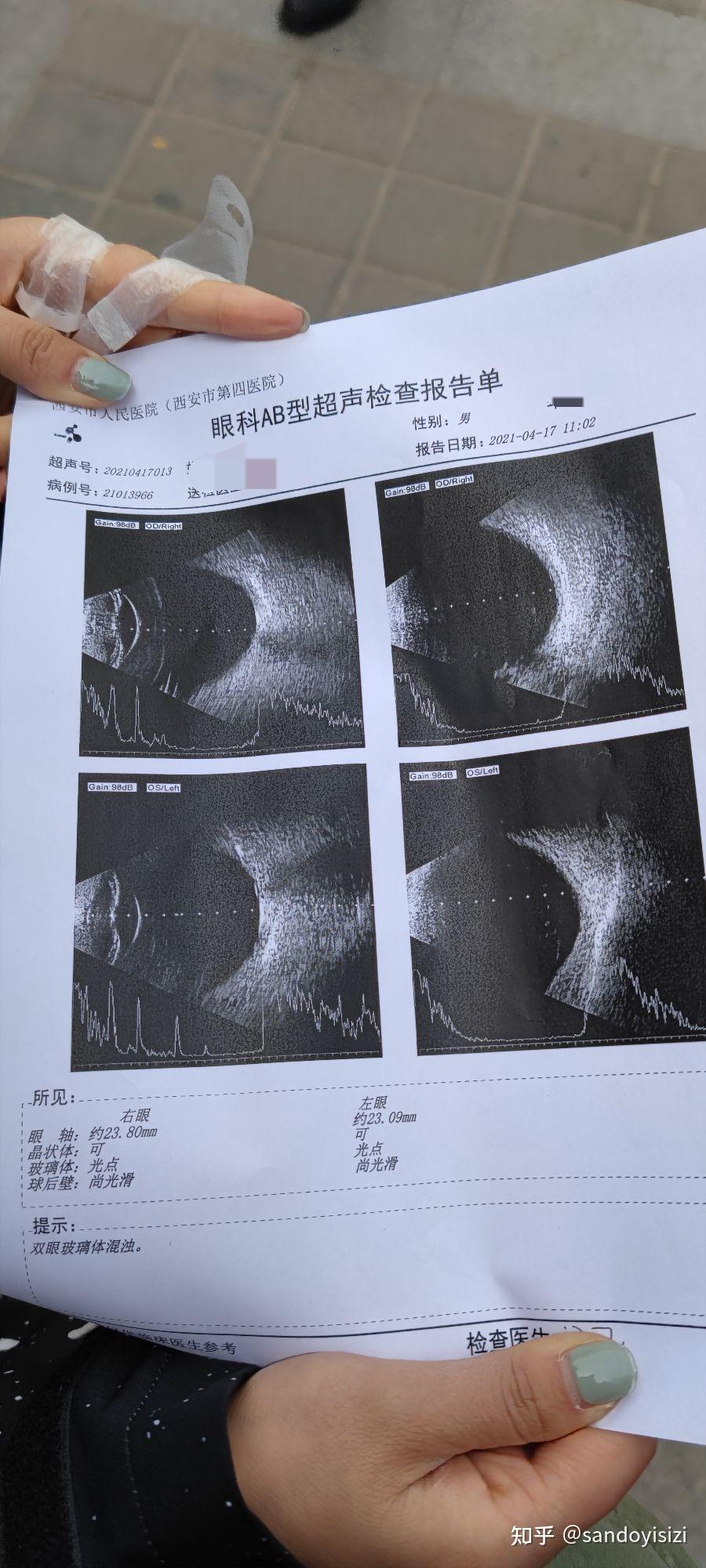 玻璃体混浊特效药介绍