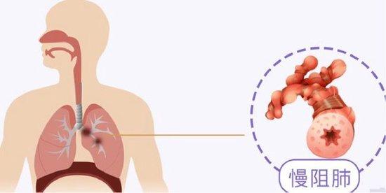 慢阻肺治疗药物解析
