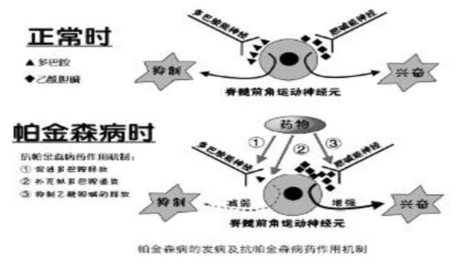 帕金森最新研究进展摘要